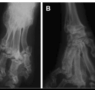 osteochondrodysplasia